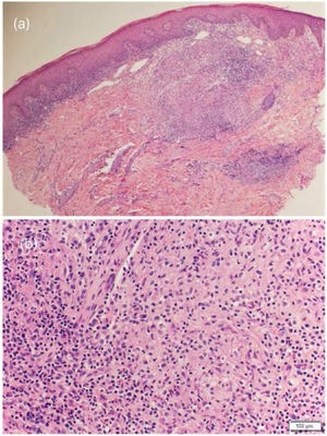 (A), Reação granulomatosa na derme superior e média; (B), granuloma não caseoso de células epitelioides com borda linfocítica periférica.