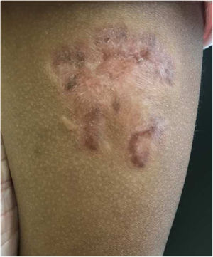 Cicatriz pós‐tratamento no local da lesão.