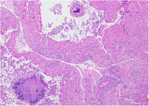Histopatologia mostrando dois tipos diferentes de colônias (Hematoxilina & eosina, 10×).