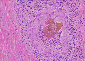 Hifas fúngicas septadas com brotamento hialino circundadas por células gigantes multinucleadas, neutrófilos, eosinófilos e linfócitos (Hematoxilina & eosina, 40×).