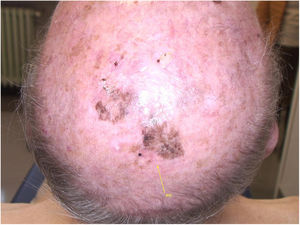 Lesão pigmentar residual após a cirurgia.