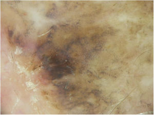 Algumas características dermoscópicas do melanoma in situ de tipo lentigo maligno.