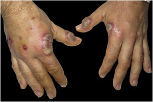 Apresentação clínica. Placas eritemato‐violáceas, pústulas e lesões bolhosas no dorso das mãos.