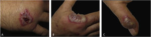 Detalhe de lesões individuais de dermatose neutrofílica do dorso das mãos. (A), Placa violácea crostosa; (B), grande bolha com base eritematosa na região radial da mão direita; (C), lesão com exsudato purulento sobre a articulação interfalangeana da mão esquerda.