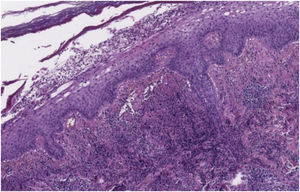 Em pequeno aumento, observa‐se epiderme acantótica e acúmulo subcórneo de grande quantidade de neutrófilos. Denso infiltrado neutrofílico está presente na derme superior (Hematoxilina & eosina, 8×).
