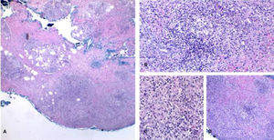 Micobacteriose cutânea causado por Mycobacterium marinum em paciente imunossuprimido por uso de infliximabe por 15 anos. Observa‐se, no limite dermo‐hipodérmico, intenso infiltrado predominantemente de histiócitos, permeado por linfócitos e neutrófilos, mas sem formar halos, nódulos, focos supurativos. Coloração: Hematoxilina & eosina; diagnóstico realizado por amplificação e por sequenciamento genético parcial do gene rpoB. (A), Paniculite, 4×; (B), granuloma malformado, 20×; (C), detalhe do infiltrado linfo‐histiocítico, 40×; (D), paniculite com esboços nodulares, 10×.