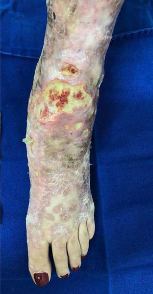 Micobacteriose cutânea não tuberculosa. Reação em cadeia da polimerase foi positiva para Mycobacterium sp. e negativa para iniciadores específicos para Mycobacterium tuberculosis. O sequenciamento genético resultou inconclusivo. O quadro apresentou cura completa após esquema de tratamento para tuberculose pulmonar associado à claritromicina.
