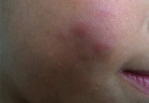 Micobacteriose cutânea por Mycobacterium fortuitum, similar ao lúpus vulgar. Diagnóstico realizado por amplificação e por sequenciamento genético parcial do gene rpoB.