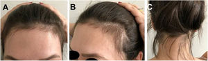 Caso 1: (A), Franja frontal, (B), rarefação temporal e (C), franja occipital de repilação após eflúvio pós‐parto.