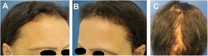 Caso 2: (A), Franja frontal, (B), rarefação temporal e (C), franja occipital de repilação após eflúvio pós‐emagrecimento.