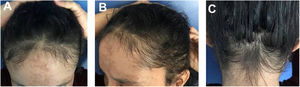 Caso 3: (A), Franja frontal, (B), rarefação temporal e (C), franja occipital de repilação após eflúvio pós‐emagrecimento.