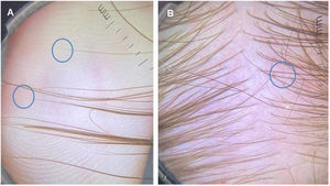 Análise das pontas dos cabelos. (A), As pontas afiladas correspondem a fios em repilação (short regrowing hairs). (B), Na tricoscopia da área occipital, vários fios curtos com pontas afiladas.