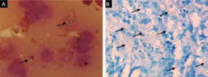Exames de úlcera facial. (A), células leveduriformes com brotamentos em esfregaço corado pelo Gram; (B), blastoconídios corados com PAS são observados na histopatologia.