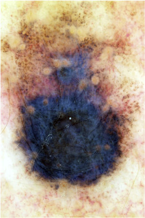 Lesão enegrecida, com 1,2cm de diâmetro, com halo hipopigmentado; na dermatoscopia, irregularidade das bordas e véu cinza‐azulado.