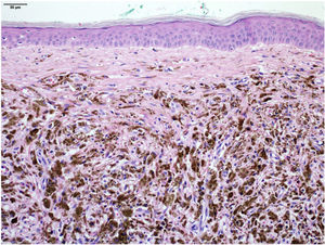 Magnificação: intenso infiltrado de melanófagos na derme (Hematoxilina & eosina, 100×).