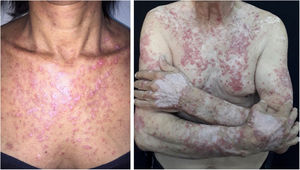 Lúpus eritematoso subagudo. Lesões eritematosas e descamativas e lesões de aspecto vitiligoide acometendo o tronco anterior e face extensora dos membros superiores e dorso das mãos.