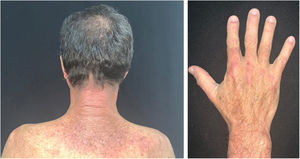 Dermatomiosite. À esquerda: eritema característico na região cervical posterior e dorso superior (“sinal do xale”). À direita: eritema no dorso das mãos (sinal de Gottron).