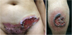 Pioderma gangrenoso. À direita: lesão ulcerada com margens irregulares, inflamatórias e elevadas, de cor vermelho‐escura ou purpúrica e base necrótica (lesão em atividade do pioderma gangrenoso). À esquerda: úlcera profunda e fundo contendo fibrina na periferia, sem borda arroxeada (lesão mais antiga, em área de cicatriz de cesariana).