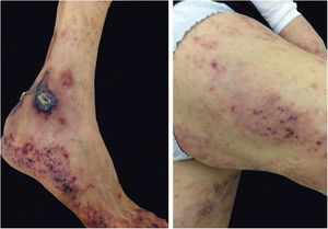 Vasculopatia trombótica crioglobulinêmica. Crioglobulinemia tipo 1 cursando com vasculopatia trombótica: máculas eritematosas e purpúricas de contorno recortado, com necrose central.