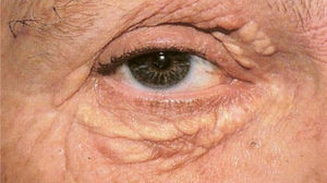 Xantelasma. Arquivo pessoal, Dr. Alexandre Gripp.