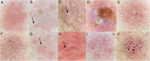 Achados dermatoscópicos dos testes de contato: (a), Eritema homogêneo; (b), Eritema perifolicular (seta); (c), Pápulas (seta); (d), Crostas; (e), Vesículas; (f), Acentuação folicular (paciente atópico); (g), Vasos lineares; (h), Petequias (seta); (i), Pústulas; (j), Padrão pórico.