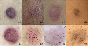 Utilidade da dermatoscopia nos testes de contato que contêm pigmento: (a1), Teste de parafenilenodiamina a olho nu, com reação duvidosa; (a2), Teste de parafenilenodiamina com reação fraca (1+); (b1), Paciente com fototipo V e reação ao níquel a olho nu, com leve eritema; (b2), O mesmo paciente com dermatoscopia mostrando eritema bem definido e reação pórica; (c1), Reação ao azul disperse a olho nu, com reação duvidosa; (c2), Reação ao azul disperse com a dermatoscopia evidenciando somente pigmento sem eritema (reação negativa); (d1 e d2), Teste com Parafenilenodiamina, a olho nu e à dermatoscopia, demostrando somente pigmentação sem eritema e reação negativa.