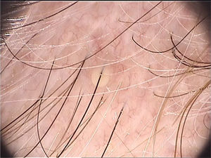 Imagem dermatoscópica de pústula folicular circundada por eritema de foliculite bacteriana (Fotofinder, magnitude original 20×). Fonte: Acervo pessoal dos autores.