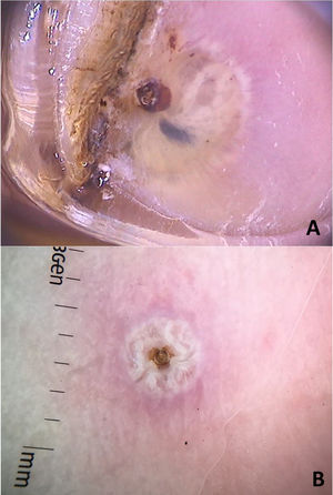 Imagens dermatoscópicas de tungíase. Anel de quitina com mancha cinza‐azulada (hematina) ao redor e estruturas esbranquiçadas em distribuição em corrente (A); anel central de quitina circundado por estruturas esbranquiçadas (ovos) (Fotofinder, magnitude original 20×) (B). Fonte: Acervo do Hospital de Clínicas de Porto Alegre e pessoal dos autores.