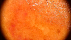 Imagem dermatoscópica de larva migrans demonstrando áreas translúcidas sem estruturas em um arranjo segmentar (Fotofinder, magnitude original 20×). Fonte: Acervo pessoal dos autores.