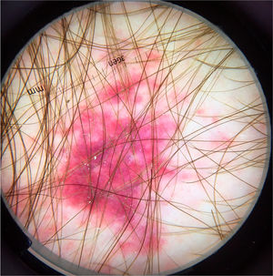 Imagem dermatoscópica de estrongiloidíase disseminada demonstrando áreas homogêneas purpúricas (Fotofinder, magnitude original 20×). Fonte: Acervo do Hospital de Clínicas de Porto Alegre.