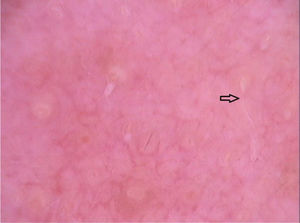 Imagem dermatoscópica de demodicidose demonstrando Demodex tails (Fotofinder, magnitude original 20×). Fonte: Acervo pessoal dos autores.
