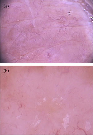 (A), Imagem dermatoscópica de hanseníase dimorfa tuberculoide demonstrando áreas de cor amarelo‐alaranjada, rodeadas por eritema e telangiectasias de ramificação linear; (B), imagem dermatoscópica de hanseníase multibacilar variante histoide demonstrando lesão papulosa com coloração amarelada difusa e múltiplas telangiectasias heteromórficas (Fotofinder, magnitude original 20×). Fonte: Acervo do Hospital de Clínicas de Porto Alegre.