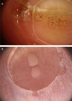 A, Imagem dermatoscópica de verruga vulgar na região subungueal demonstrando hiperceratose e vasos em ponto ou trombosados; B, Imagem dermatoscópica de verruga plana demonstrando discretos vasos em ponto homogeneamente distribuídos (Fotofinder, magnitude original 20×). Fonte: Acervo pessoal dos autores.