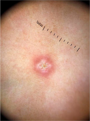 Imagem dermatoscópica de leishmaniose tegumentar americana demonstrando ulceração central com áreas brancas homogêneas e eritema com vasos lineares na periferia (Fotofinder, magnitude original 20×). Fonte: Acervo do Hospital de Clínicas de Porto Alegre.