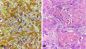 (A), Numerosos esporos fúngicos (Grocott, 400×). (B), Proliferação de células tumorais com presença de mitoses atípicas e pérolas córneas (Hematoxilina & eosina).