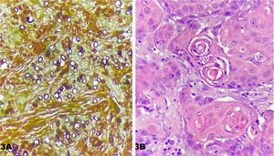 (A), Numerosos esporos fúngicos (Grocott, 400×). (B), Proliferação de células tumorais com presença de mitoses atípicas e pérolas córneas (Hematoxilina & eosina).