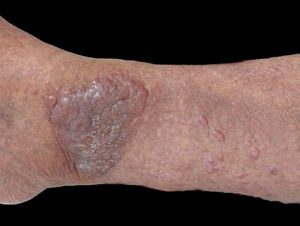 Pápulas de aspecto queloidiformes, eritematosas e grande tumoração no tornozelo.