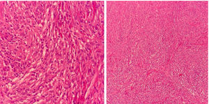 Histiócitos fusiformes, dispostos em feixes curtos, ocupando a derme à coloração (Hematoxilina & eosina, 100× e 400×).