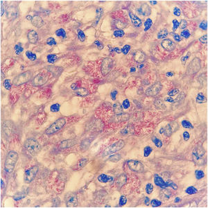 Presença de inúmeros bacilos ácido‐álcool resistentes à coloração de Fite‐Faraco, 1000×.