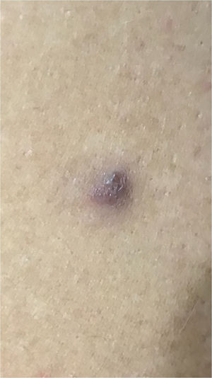 Nódulo angiomatoso na face lateral do braço esquerdo.