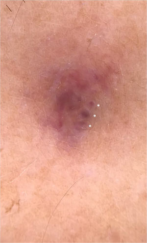 À dermatoscopia, área arroxeada homogênea, sem estruturas, circundada por uma região esbranquiçada, além de lagunas intensamente arroxeadas destacando‐se individualmente da área sem estruturas e circundadas por um halo pálido (asteriscos).