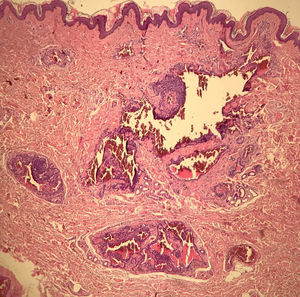 À histologia, ninhos intradérmicos de células glômicas monomórficas, com núcleo arredondado, organizados em cordões, únicos ou múltiplos ao redor de estruturas vasculares exuberantes, correspondendo a glomangioma (Hematoxilina & eosina, 40×).