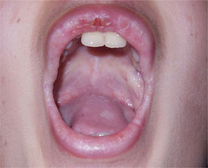 Aspecto clínico – placas xantomatosas no palato.