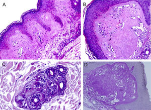 Microscopia óptica. A, Depósito eosinofílico na derme papilar (Hematoxilina & eosina, 150×). (B), Detalhe da derme papilar com homogeneização acentuada e ectasia vascular (Hematoxilina & eosina, 400×). (C), Discreto depósito ao redor de glândula sudorípara (Hematoxilina & eosina, 400×). (D), Coloração PAS demonstrando positividade diastase resistente na derme papilar (ácido periódico de Schiff, 400×).