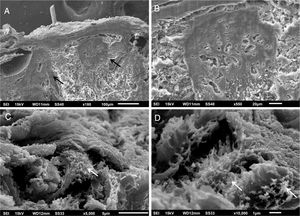 Microscopia eletrônica de varredura. (A), Pequeno aumento demonstrando homogeneização da derme papilar (setas) (180×). (B), Detalhe da derme papilar com compactação acentuada (550×). (C e D), Depósito fibrilar na derme média (setas) (5.000 e 10.000×).