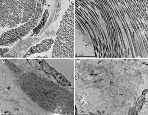 Microscopia eletrônica de transmissão. (A), Depósito de material fibrilar (setas) entre feixes colágenos (col) (15.000×). (B), Depósito fibrilar entre fibras colágenas (setas) (25.000×). (C), Depósito fibrilar ao redor de fibra elástica (FE) (30.000×). (D), Área com deposição importante do material fibrilar com deslocamento das fibras colágenas (25.000×).