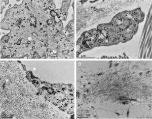 Microscopia eletrônica de transmissão. (A e B), Presença de material fibrilar dentro de estruturas celulares (25.000 e 40.000×). (C e D), Grandes aumentos com detalhe da natureza fibrilar dos depósitos (50.000 e 50.000×).
