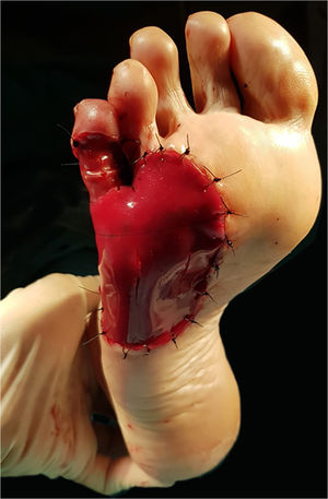 Um curativo de matriz de duas camadas foi utilizado para cobrir o defeito plantar e a quinta falange proximal. Algumas pequenas incisões verticais foram feitas sobre a camada externa da matriz para facilitar a drenagem de exsudato ou hematoma.