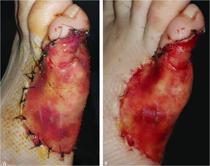 Três semanas após a colocação da matriz. (A), A matriz mostra um tom laranja através da camada externa de silicone. (B), A camada externa de silicone é facilmente removida e a “neoderme” é temporariamente exposta e coberta por um enxerto de pele de espessura parcial.