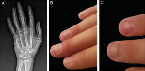 Imagens clínicas e radiológicas do caso 2. (A), Fraturas do quarto e quinto ossos metacarpais (imagem de raios‐X); (B), Edema da prega ungueal do terceiro e quarto dedos. (C), Onicomadese nos dois dedos.